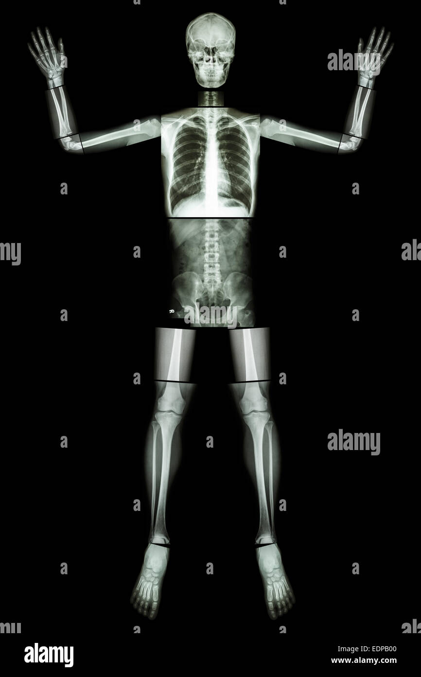 Give Up EBOLA. (Human bone raise the hand) (Whole body : head neck spine shoulder arm elbow forearm wrist hand finger thorax hea Stock Photo