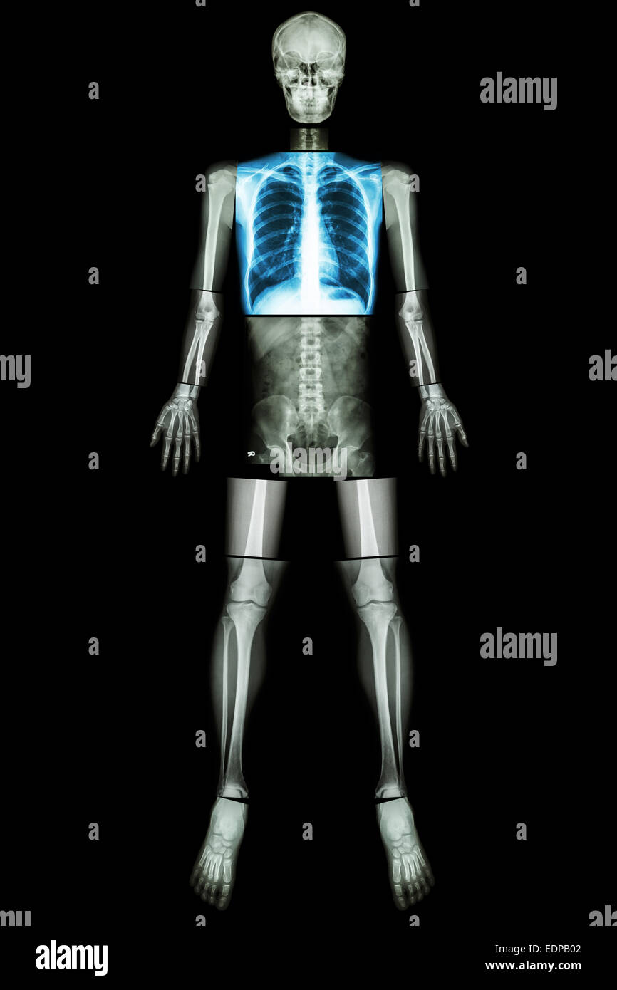 Lung healthy (X-ray Whole body : skull head neck spine shoulder chest thorax lung pulmonary heart rib arm elbow forearm wrist ha Stock Photo