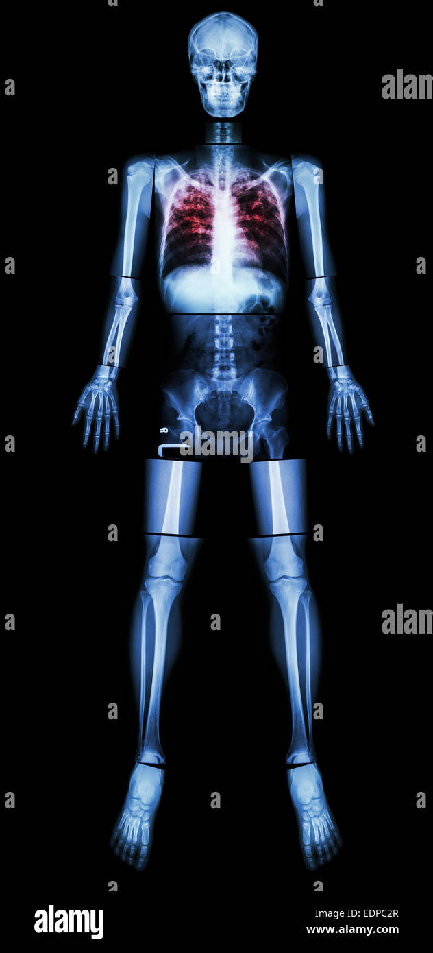 Pulmonary Tuberculosis(TB)(X-ray whole body : head skull neck spine shoulder arm elbow forearm wrist hand finger thorax chest he Stock Photo