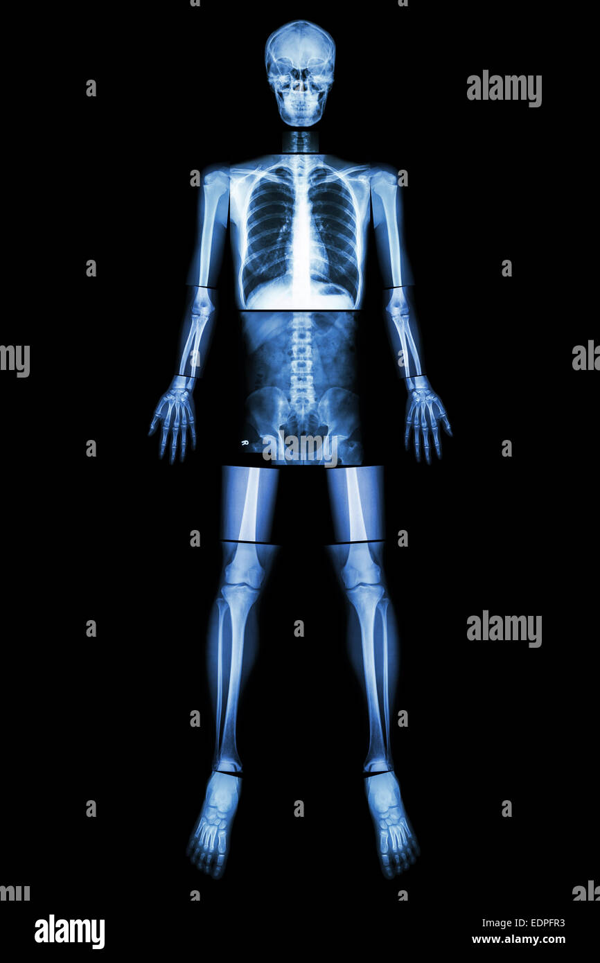 Anatomical Position. (X-ray whole body : head ,neck ,thorax ,heart ,lung ,rib ,shoulder ,scapula ,arm ,forearm ,elbow ,wrist ,ha Stock Photo