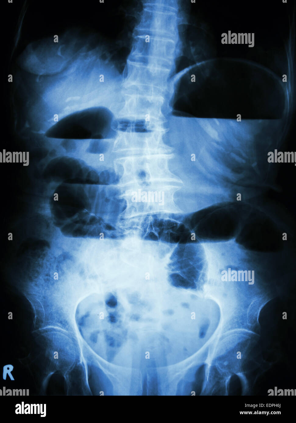 Small bowel obstruction. Film Xray abdomen upright show small bowel