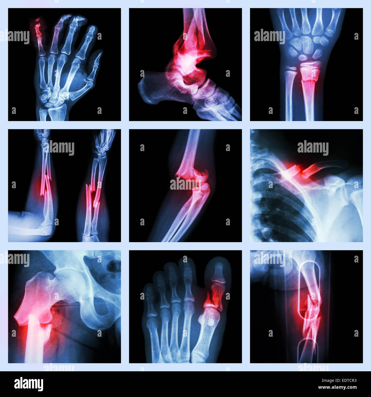 Collection of bone fracture Stock Photo