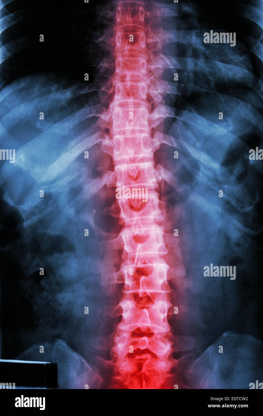 film x-ray T-L spine(Thoracic-Lumbar spine) show : human's thoracic-lumbar spine and inflammation at spine Stock Photo