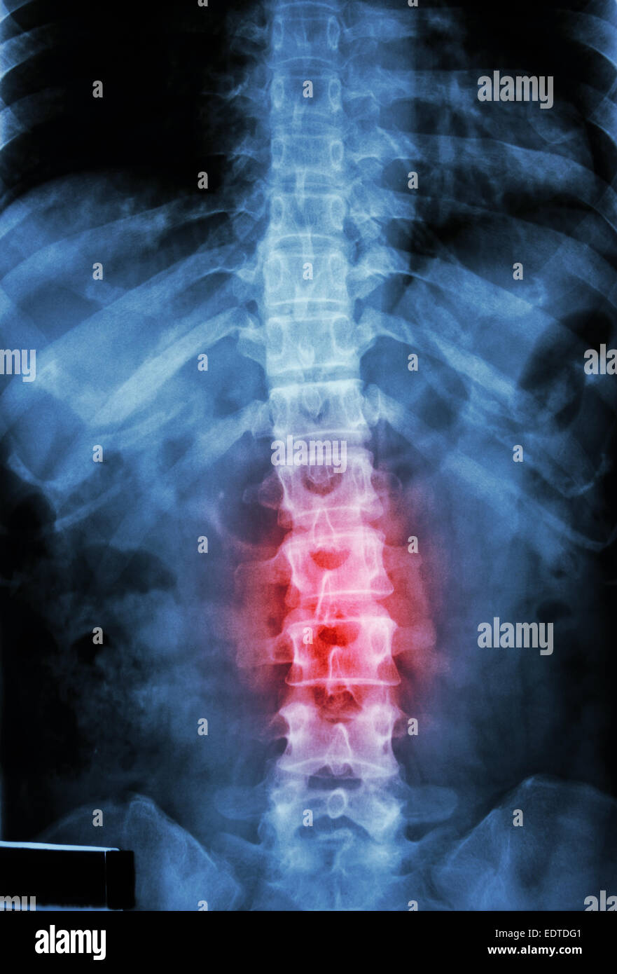 film x-ray T-L spine(Thoracic-Lumbar spine) show : human's thoracic-lumbar spine and inflammation at lumbar spine Stock Photo
