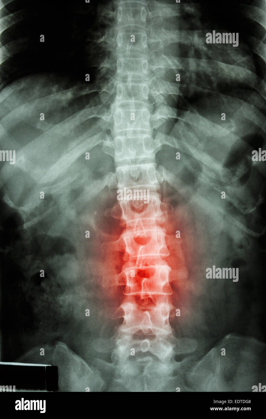 X ray normal lumbar spine hires stock photography and images Alamy