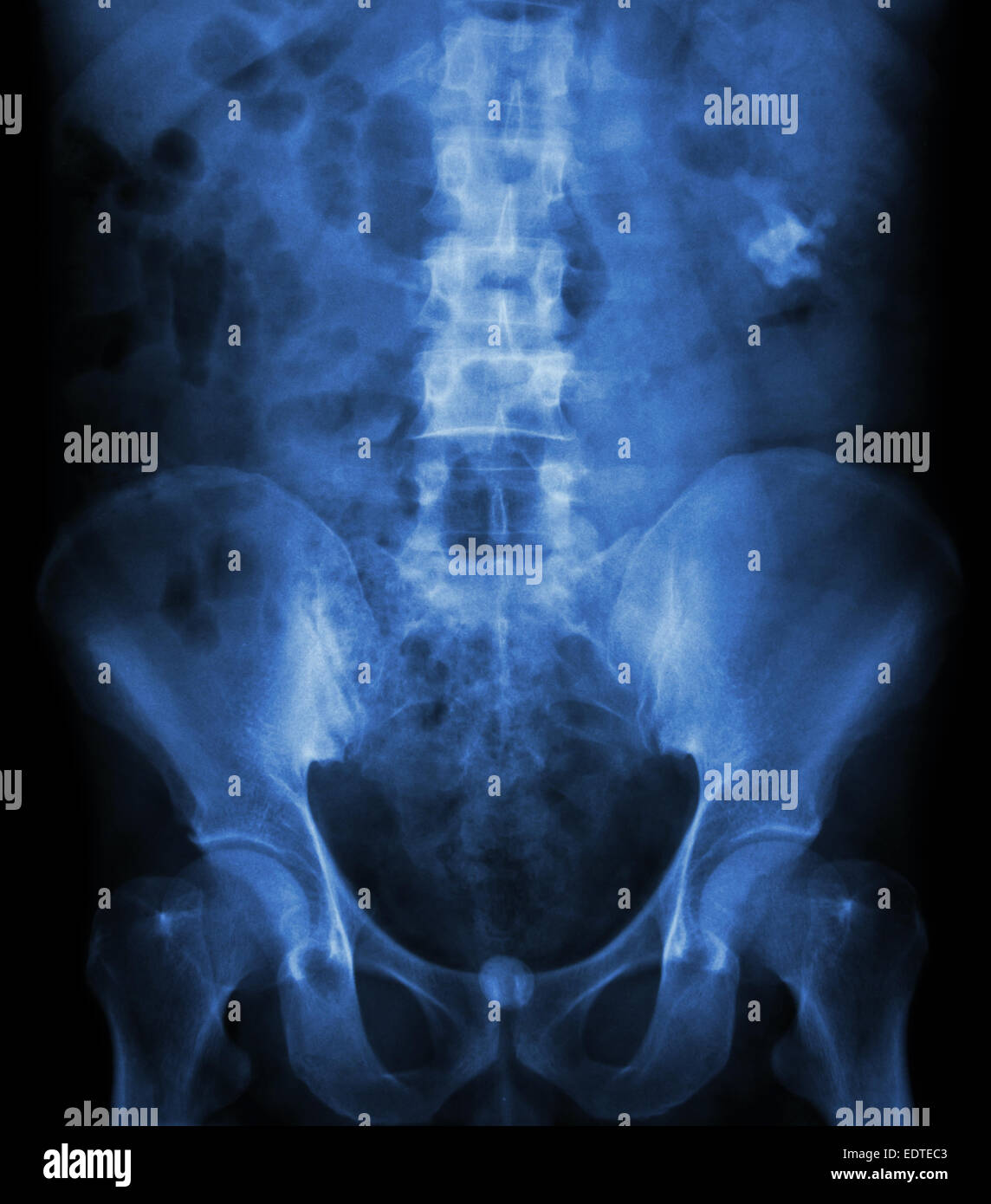 Left kidney stone(opaque area at right upper of image) and bladder stone(opaque area at lower of image) Stock Photo