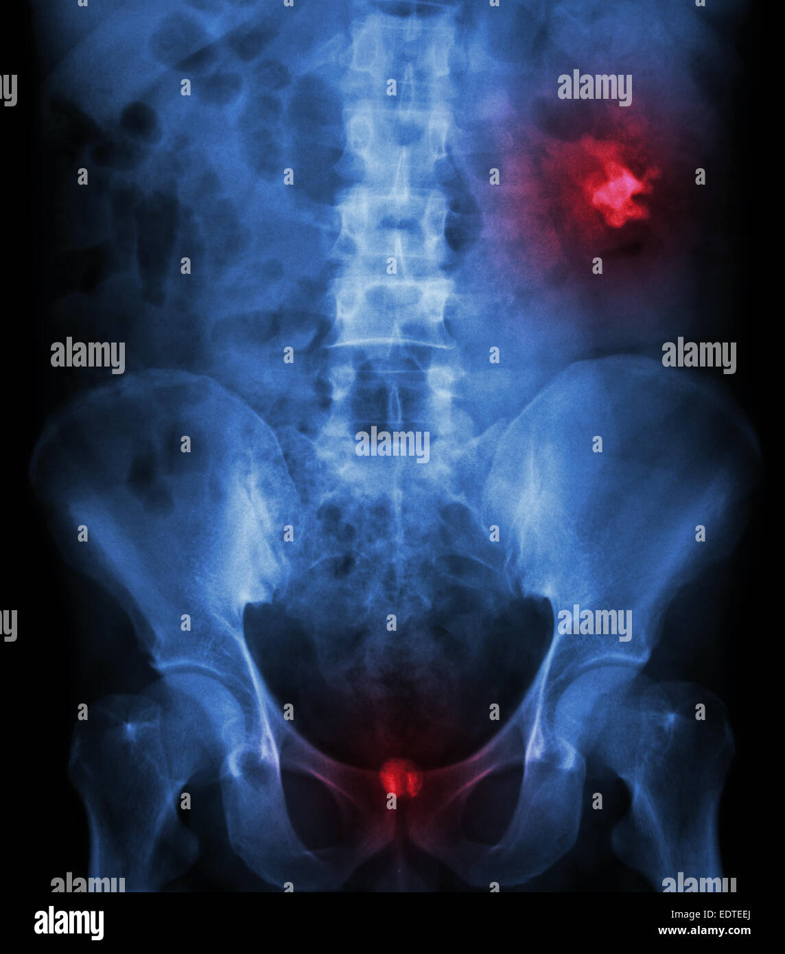 Left kidney stone(opaque area at right upper of image) and bladder stone(opaque area at lower of image) Stock Photo