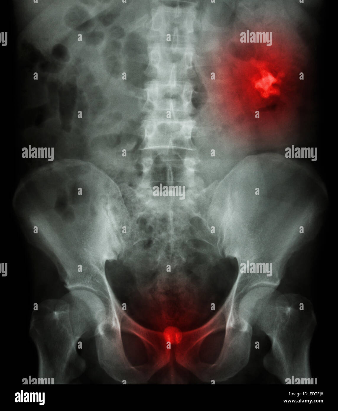 Left kidney stone(opaque area at right upper of image) and bladder stone(opaque area at lower of image) Stock Photo