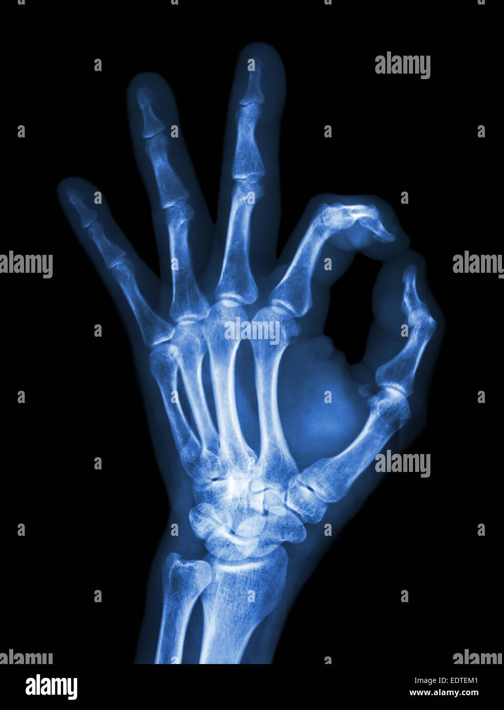 X-ray hand with OK symbol Stock Photo