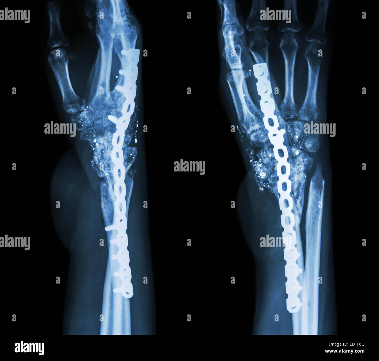 Compression Fracture Wrist