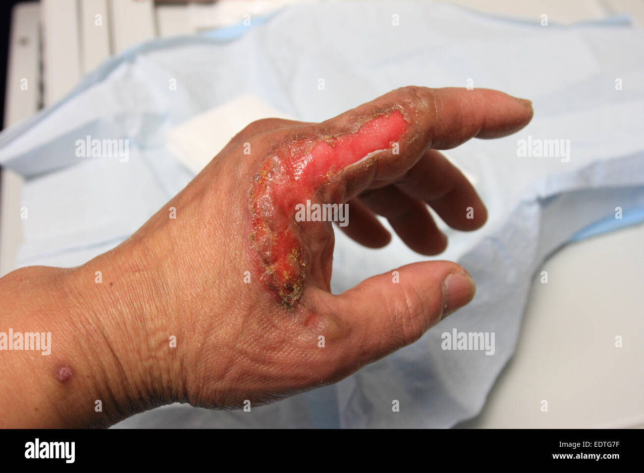 Second degree burn hi-res stock photography and images - Alamy