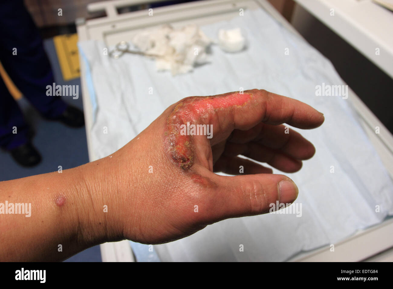 male left hand has accident, second degree burn, healing wound on left hand, Norfolk, UK Stock Photo