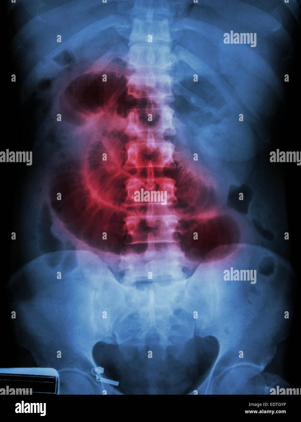 'Small intestine obstruction'  Film X-ray abdomen supine : Show small intestine dilate Stock Photo