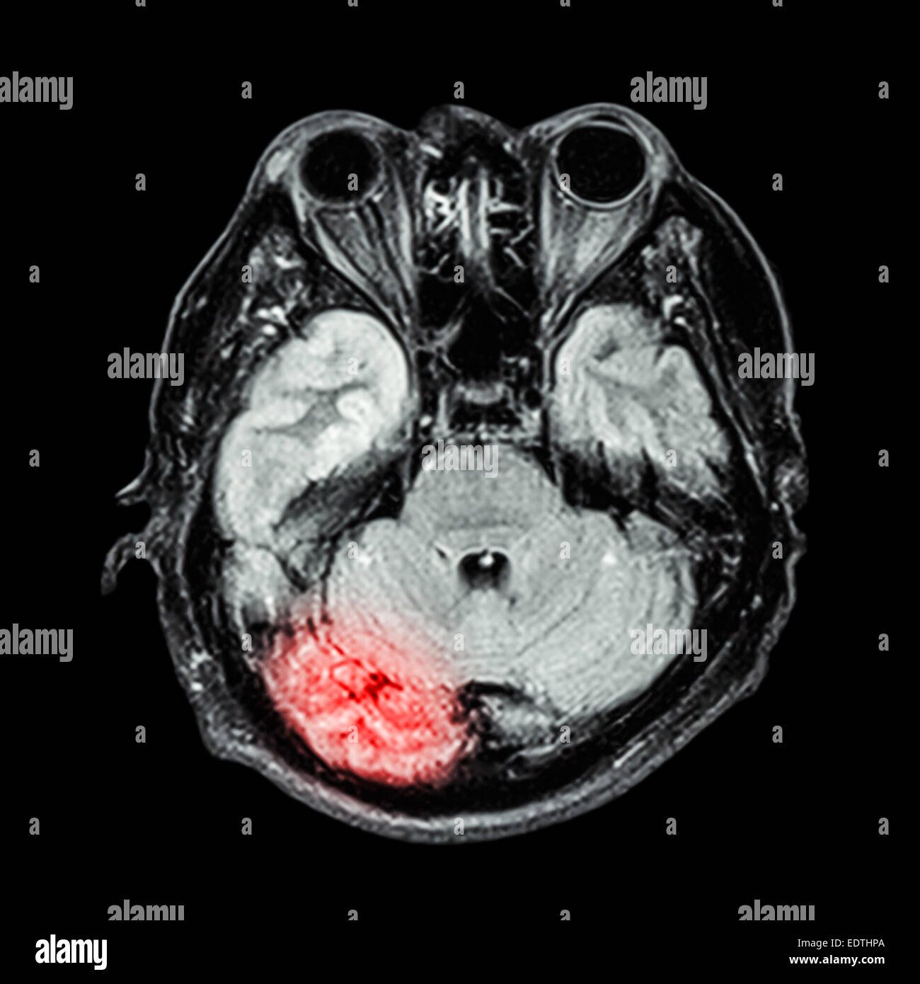 Brain injury , Stroke  ( MRI brain ) Stock Photo