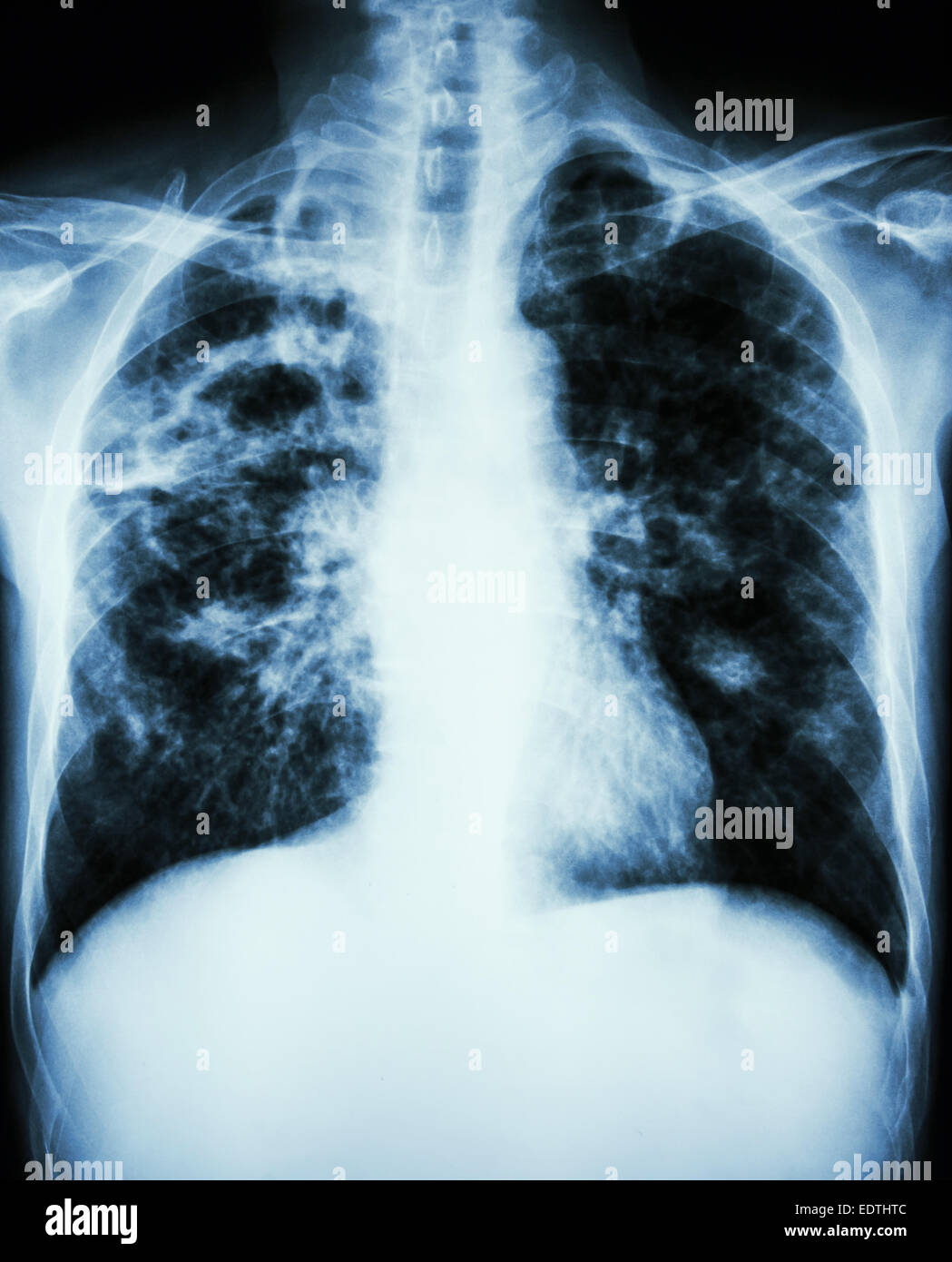 film chest xray show cavity at right lung,fibrosis & interstitial