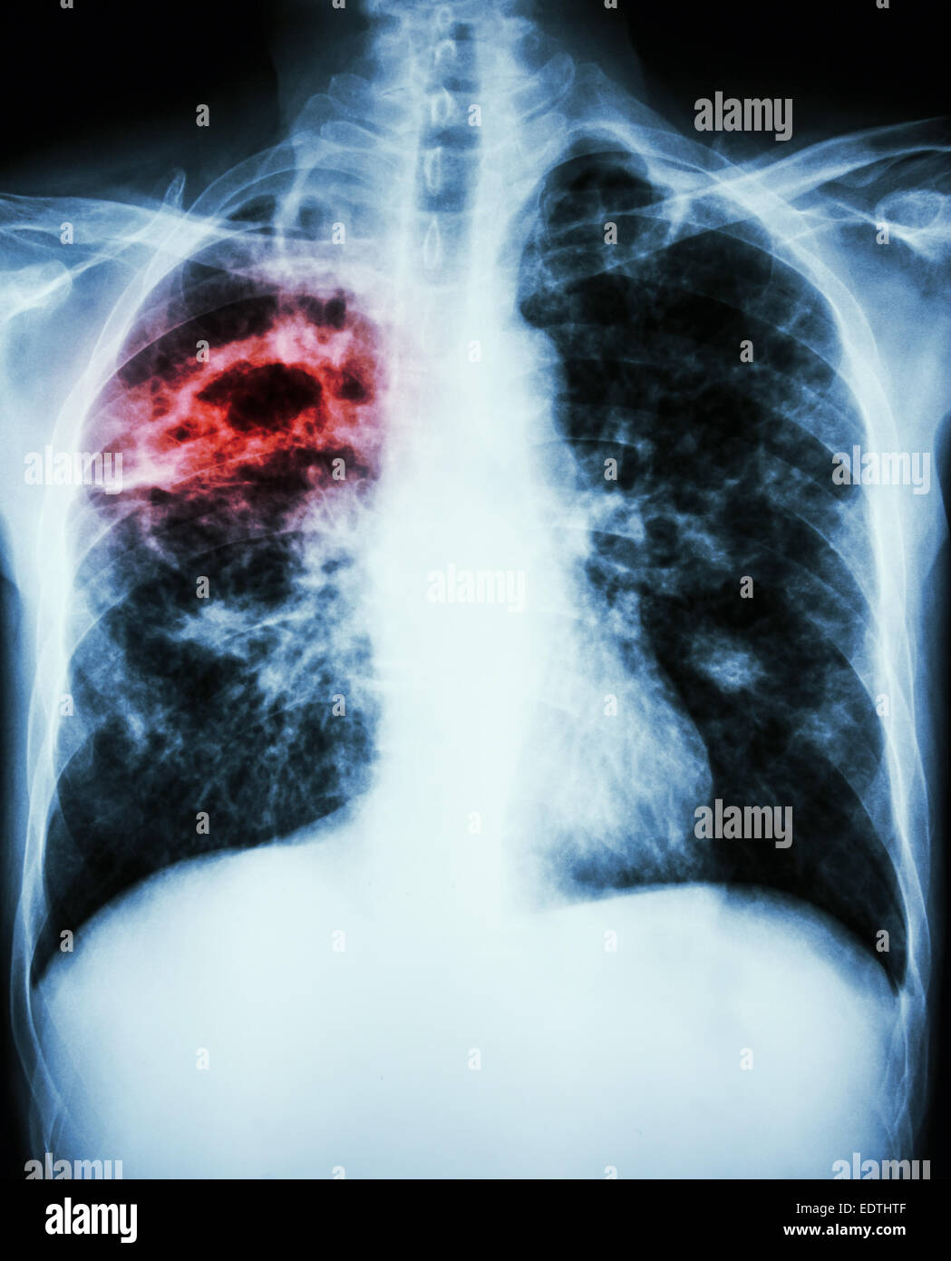 film chest xray show cavity at right lung,fibrosis & interstitial