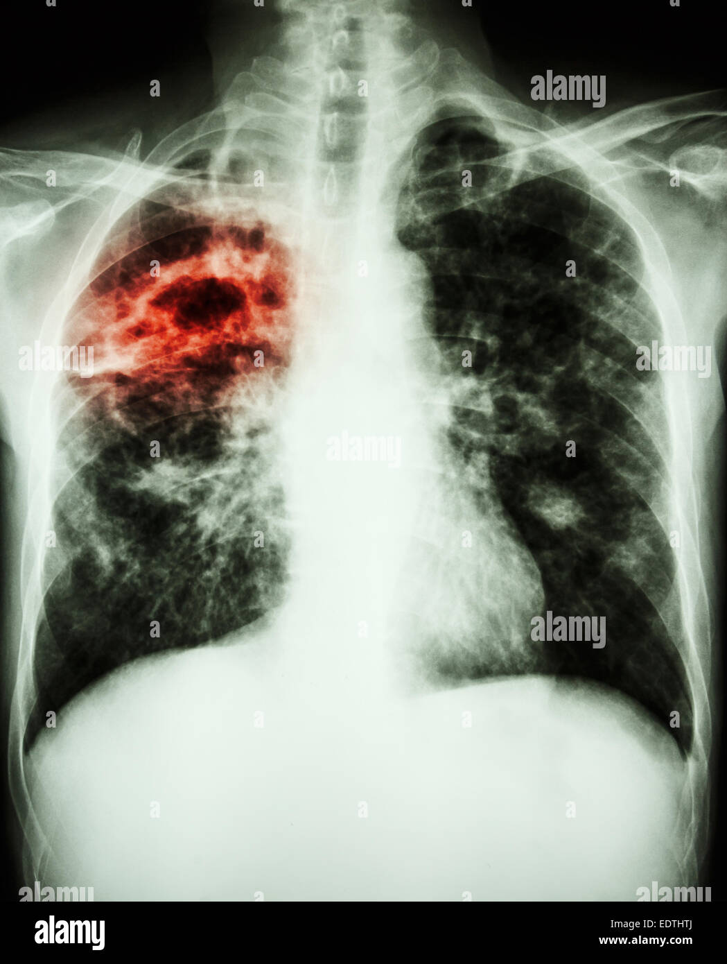 film chest xray show cavity at right lung,fibrosis & interstitial