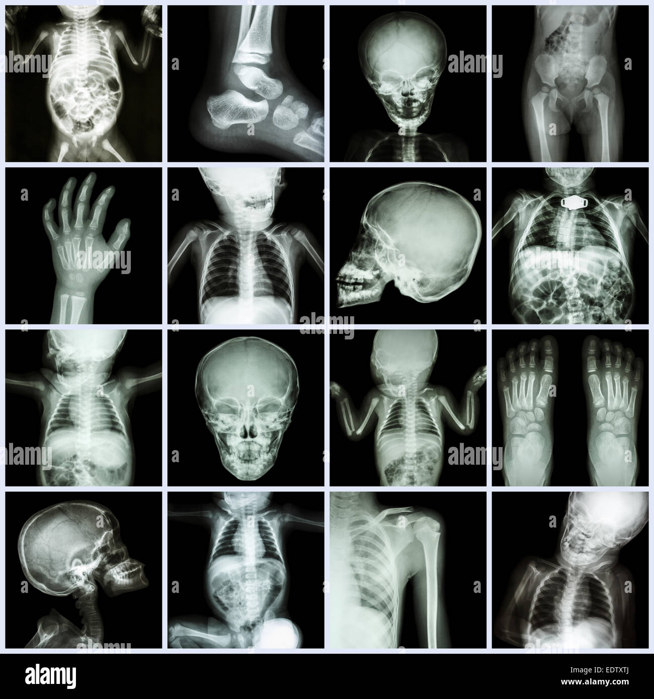 Collection X-ray part of child body ( Whole body : skull head neck face spine shoulder chest thorax lung heart abdomen arm elbow Stock Photo