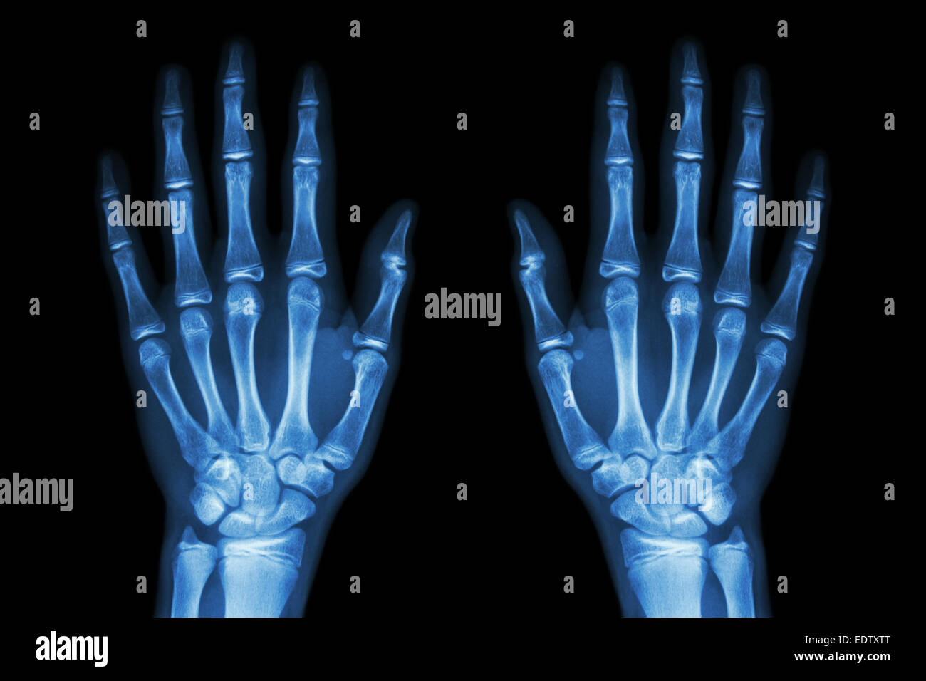 X-ray normal human hands (front) on black background Stock Photo