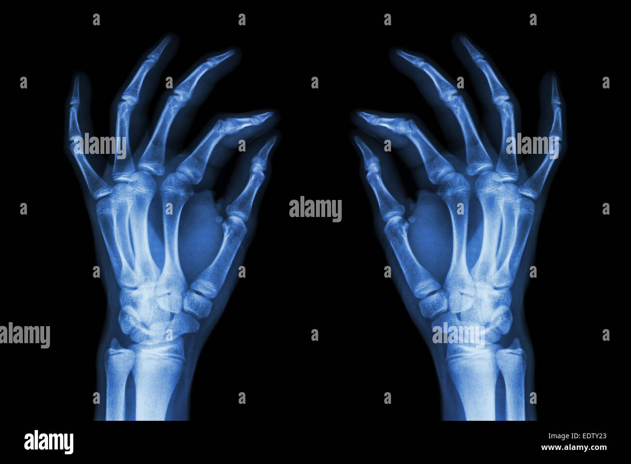 X Ray Normal Hand High Resolution Stock Photography And Images Alamy