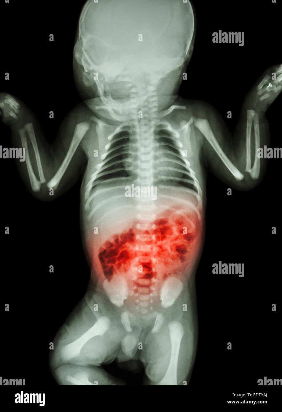 Enteritis (X-ray of sick infant and inflammation of intestine) Stock Photo