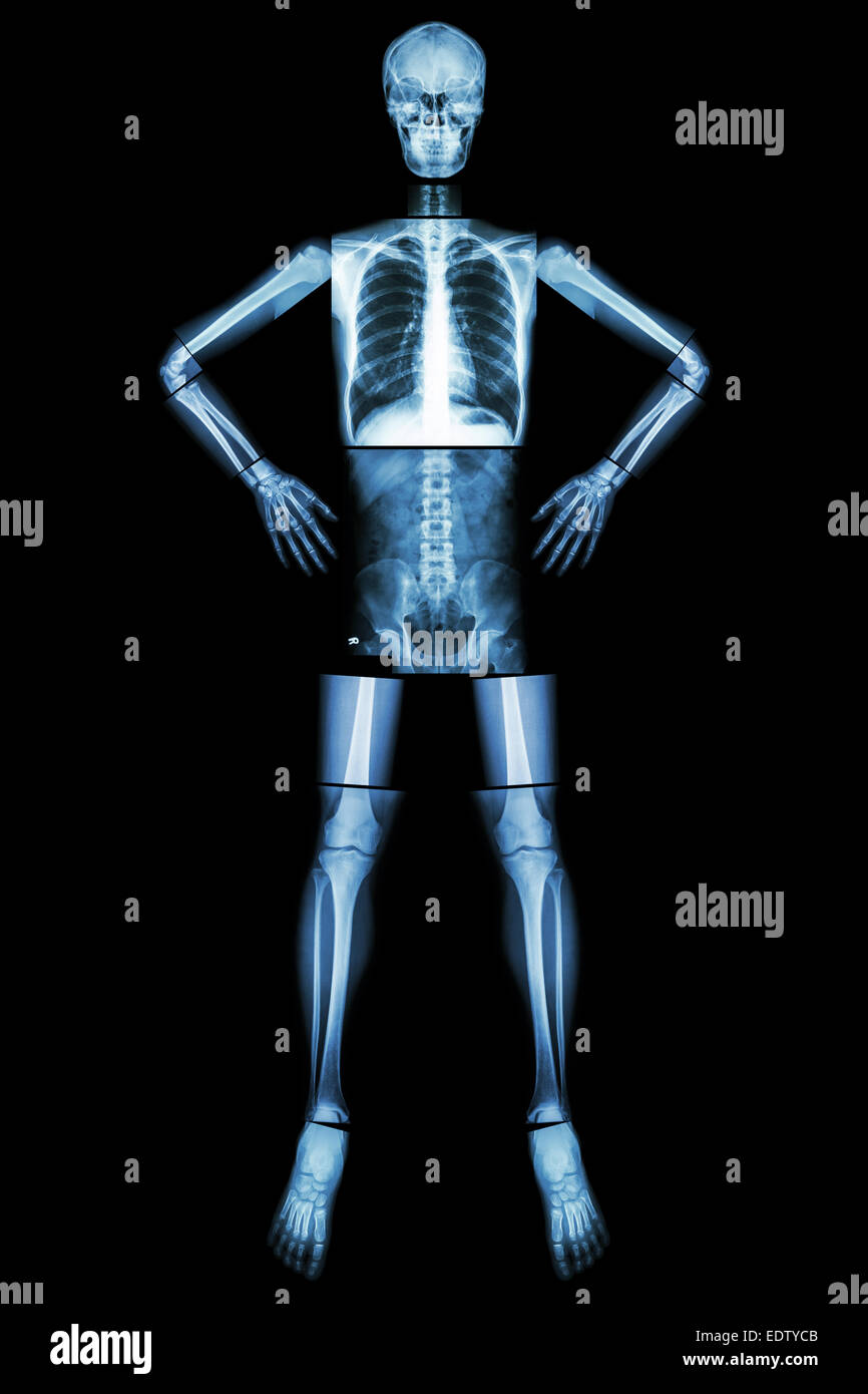 Human bone stand and akimbo (X-ray whole body : head skull neck spine shoulder arm elbow forearm wrist hand finger chest thorax Stock Photo