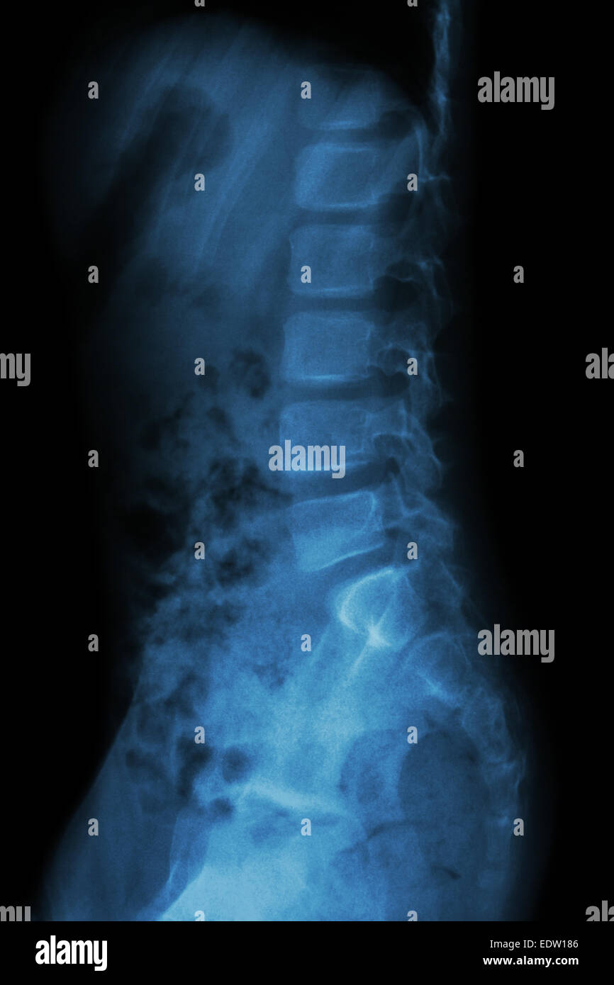 Lumbar spine of child ( X-ray thoracic - lumbar spine ) ( lateral view ) Stock Photo