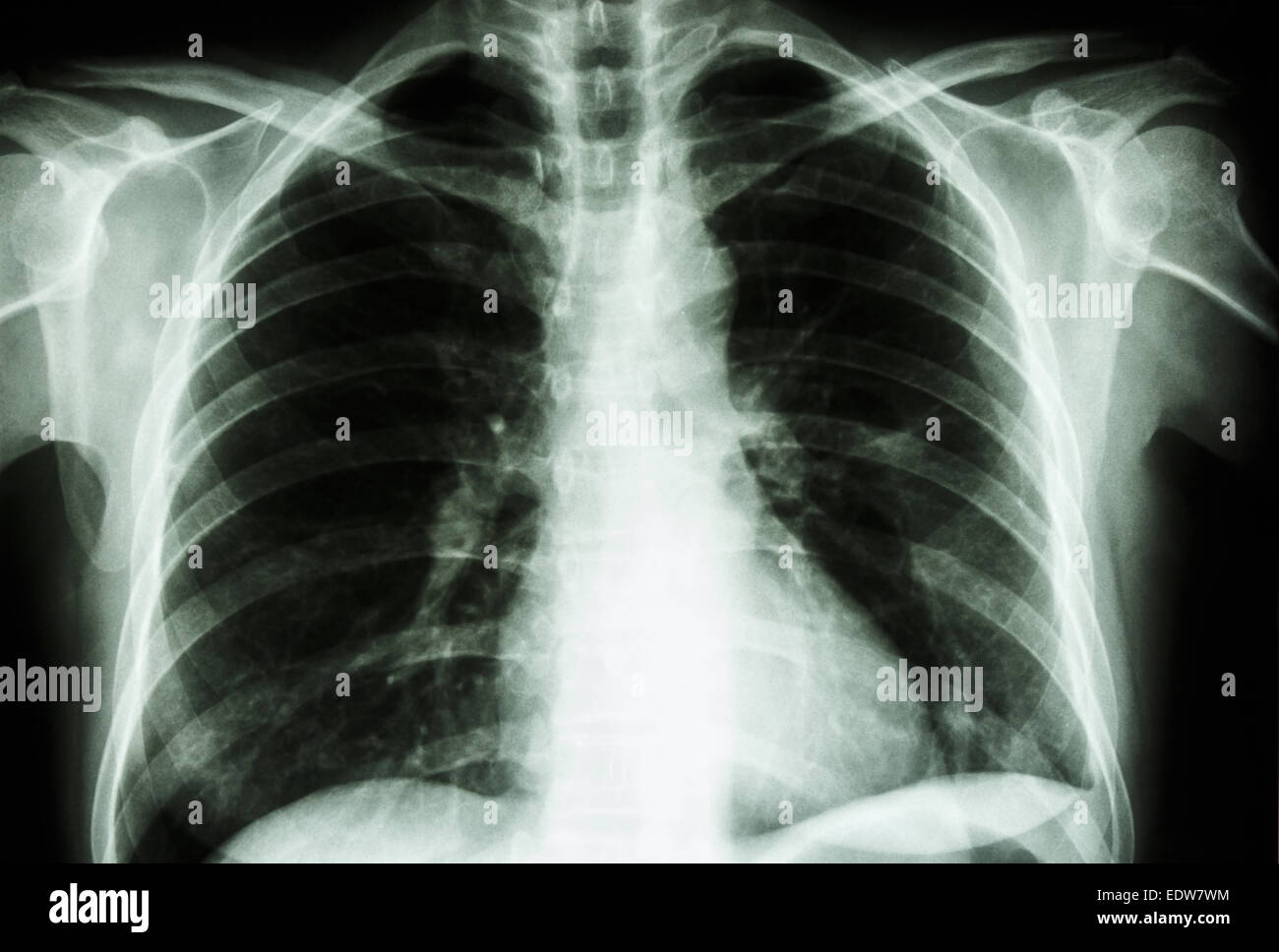 Normal lung hires stock photography and images Alamy