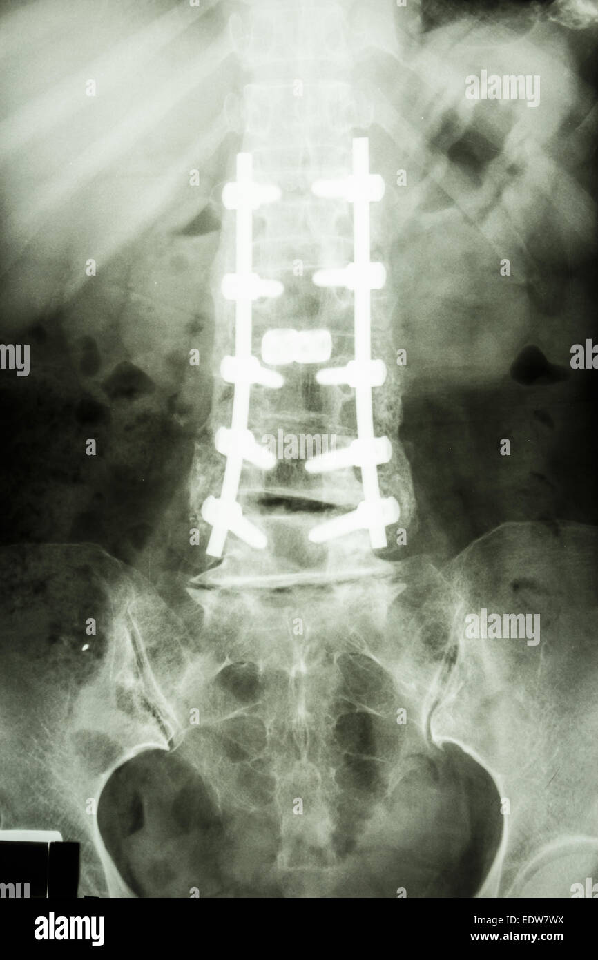 film Xray show lumbar spine with pedicle screw fixation in