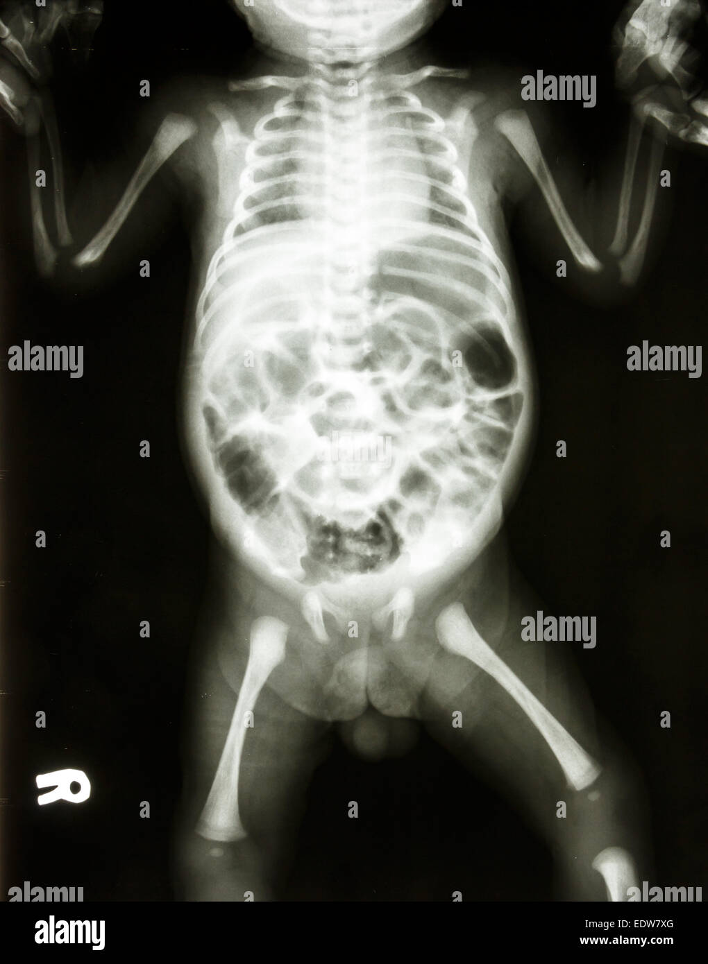 film X-ray show normal skeleton of infant Stock Photo