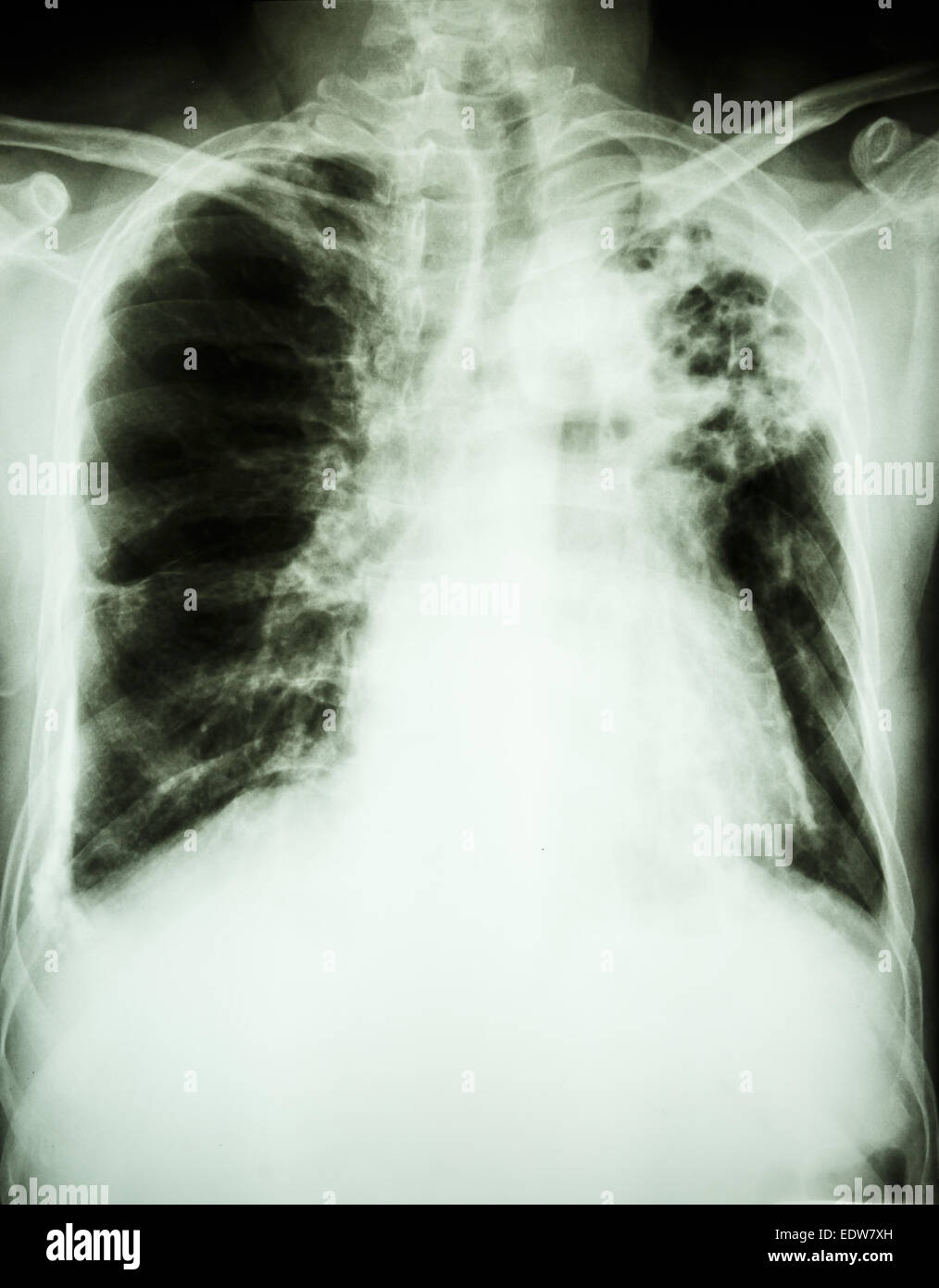 Film Xray show patchy infiltrate at left upper lung from Mycobacterium