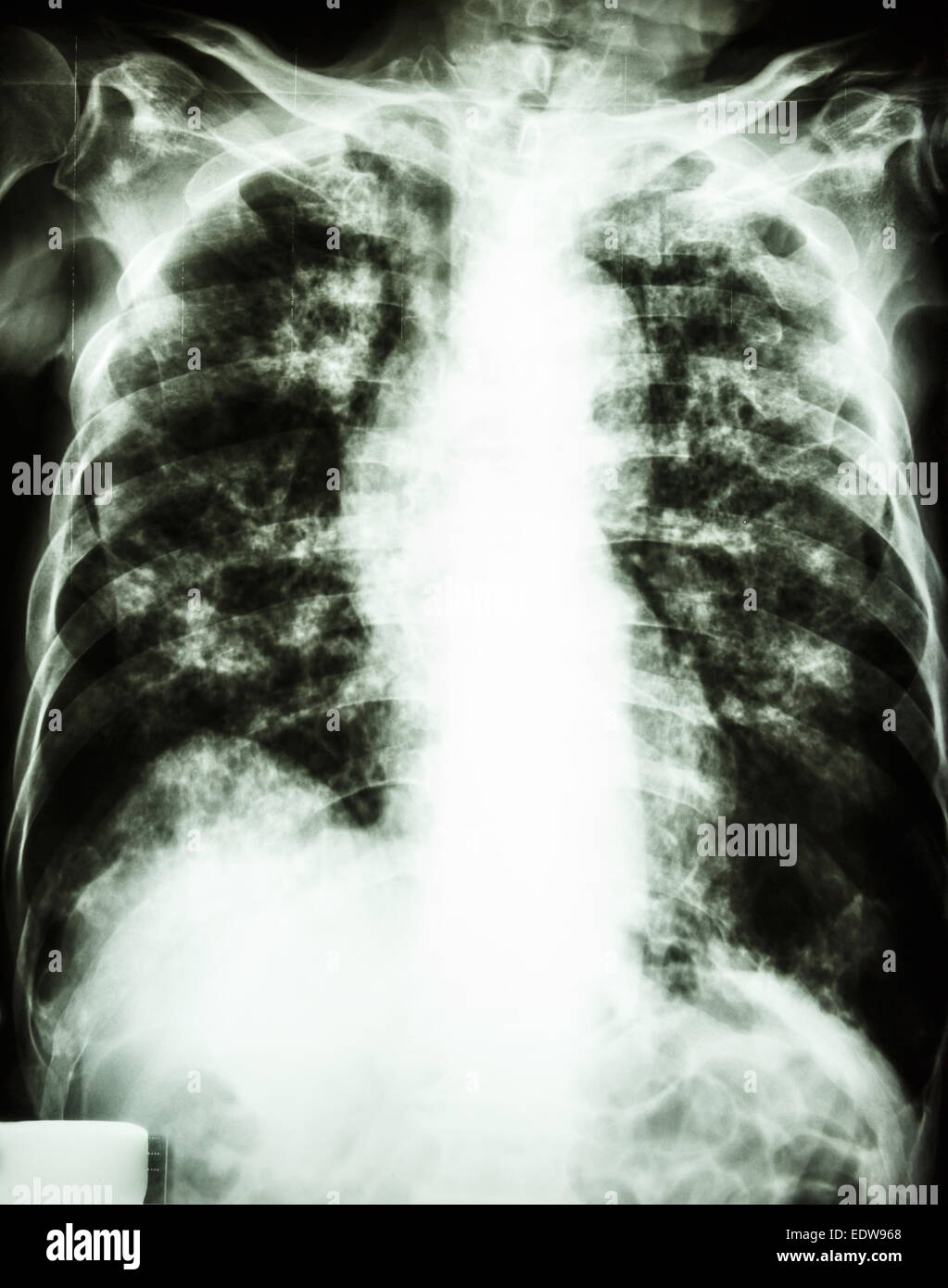 film chest xray show interstitial infiltrate and alveolar infiltrate