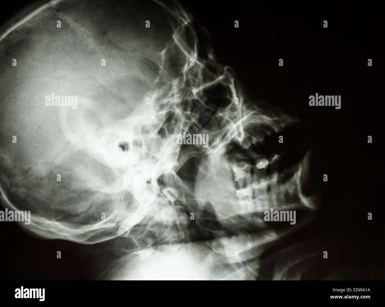 film skull lateral and upward show normal human's skull and blank area at right side Stock Photo