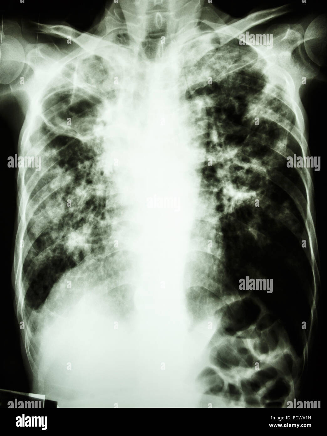 film chest xray show cavity at right lung,fibrosis & interstitial