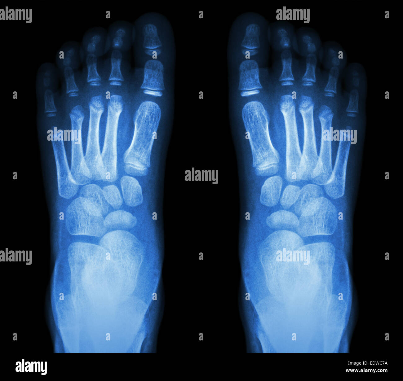X-ray normal child's foots Stock Photo