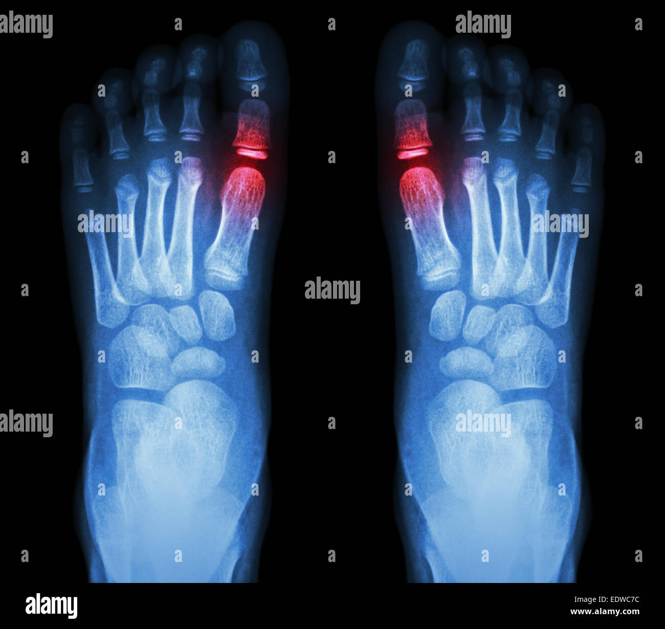 'Rheumatoid arthritis , Gouty arthritis'  X-ray child's foots and arthritis at metatarsophalangeal joint (Big toe area) Stock Photo