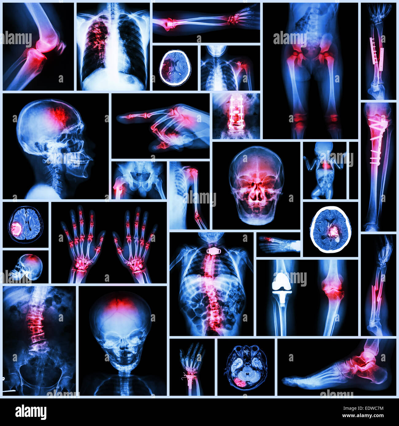 Collection X-ray part of human,Orthopedic operation,Multiple disease (Fracture,Gout,Rheumatoid arthritis,Osteoarthritis knee,Str Stock Photo