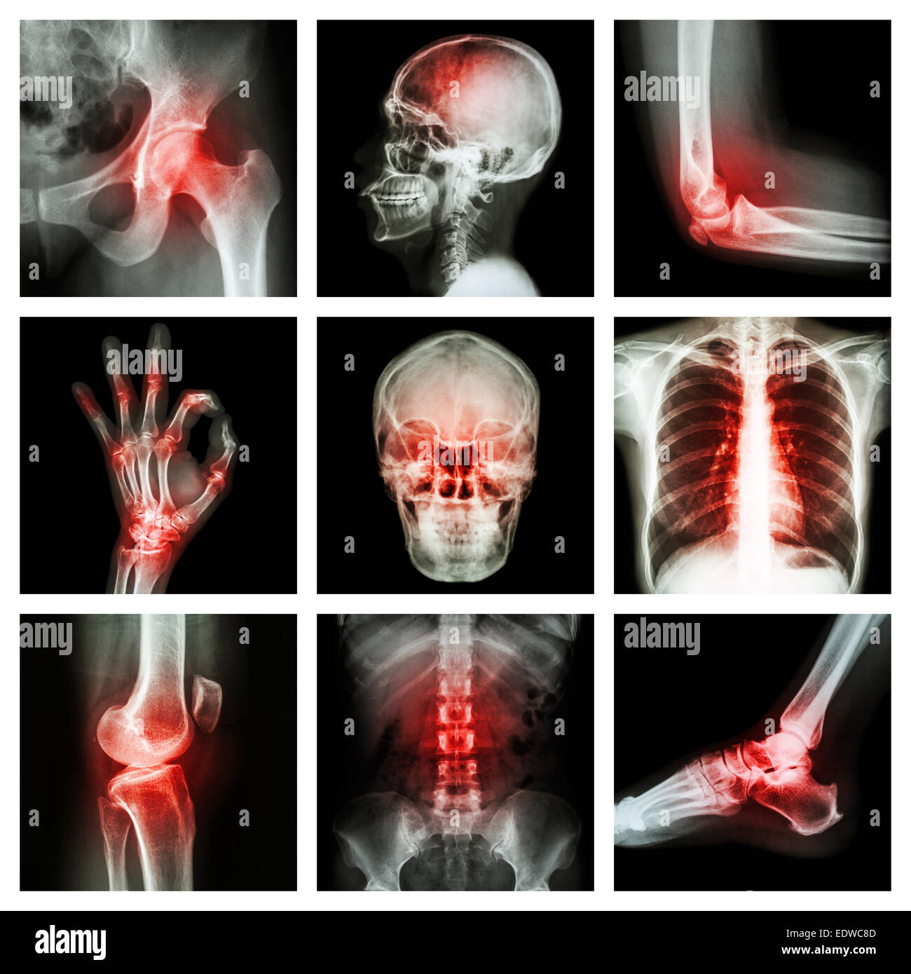 Collection X-ray and multiple injury Stock Photo