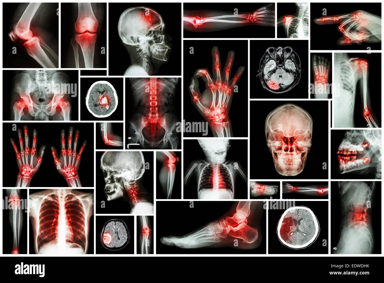 X-ray multiple part of human with multiple disease (stroke, arthritis, gout, rheumatoid, brain tumor, osteoarthritis, etc) Stock Photo