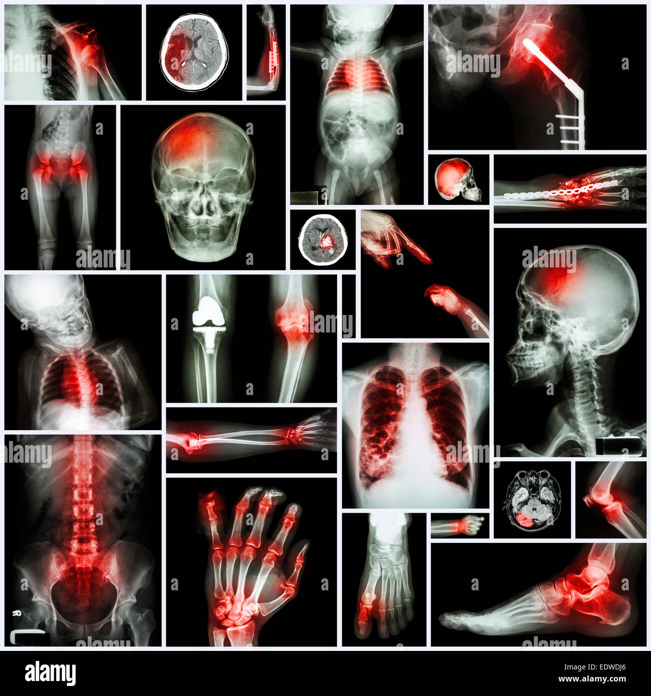 Collection of X-ray multiple part of human,Orthopedic operation and multiple disease (Shoulder dislocation,Stroke,Fracture,Gout, Stock Photo
