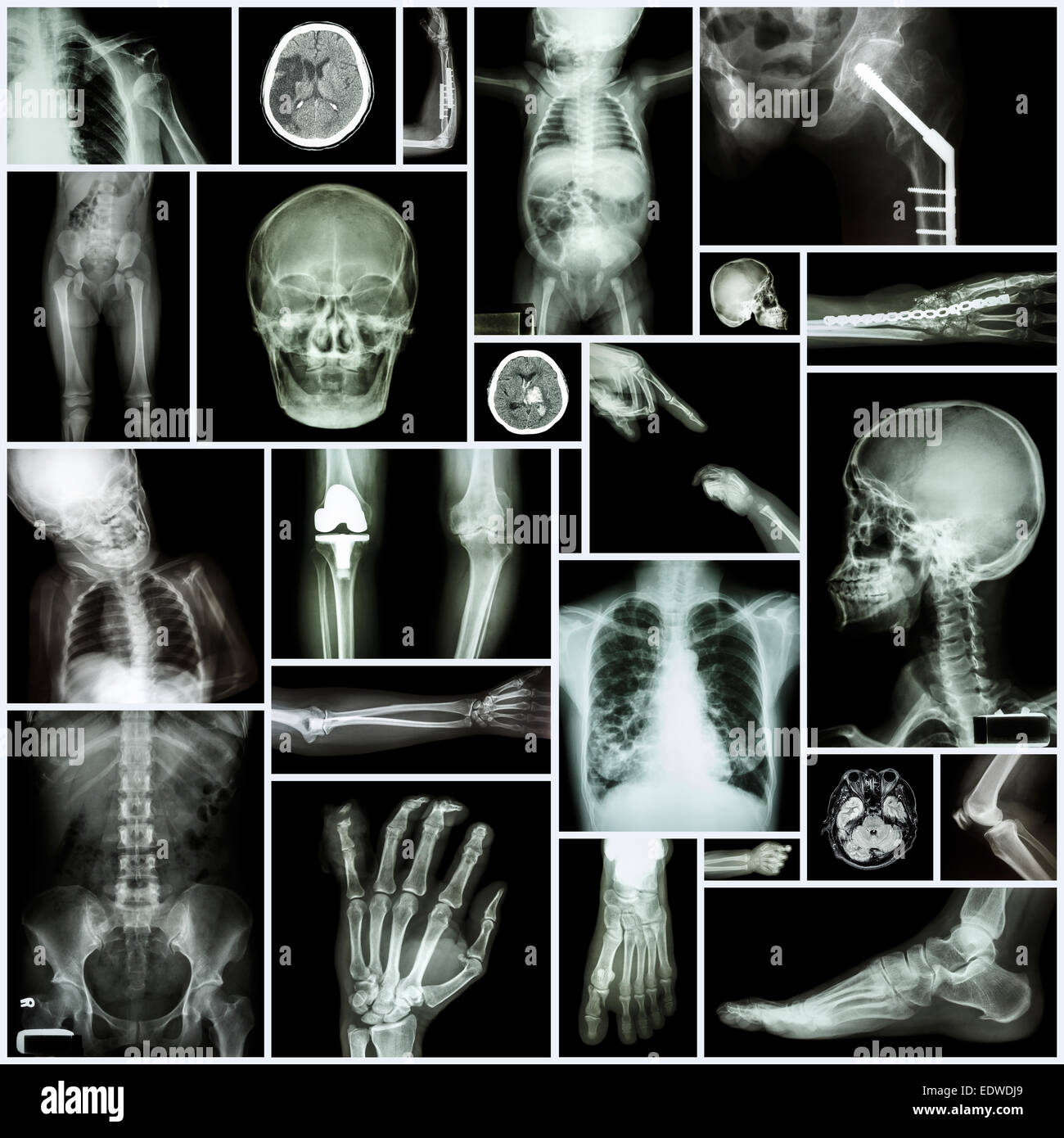Collection X-ray 'Multiple part of human' ,'Orthopedic surgery' and 'Multiple disease' (Fracture,Shoulder dislocation,Osteoarthr Stock Photo