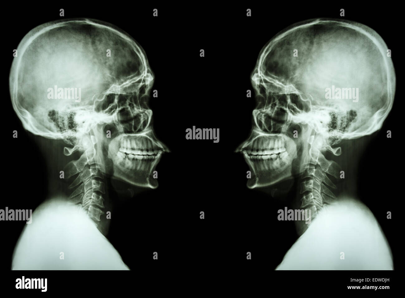 X-ray Skull and cervical spine Stock Photo