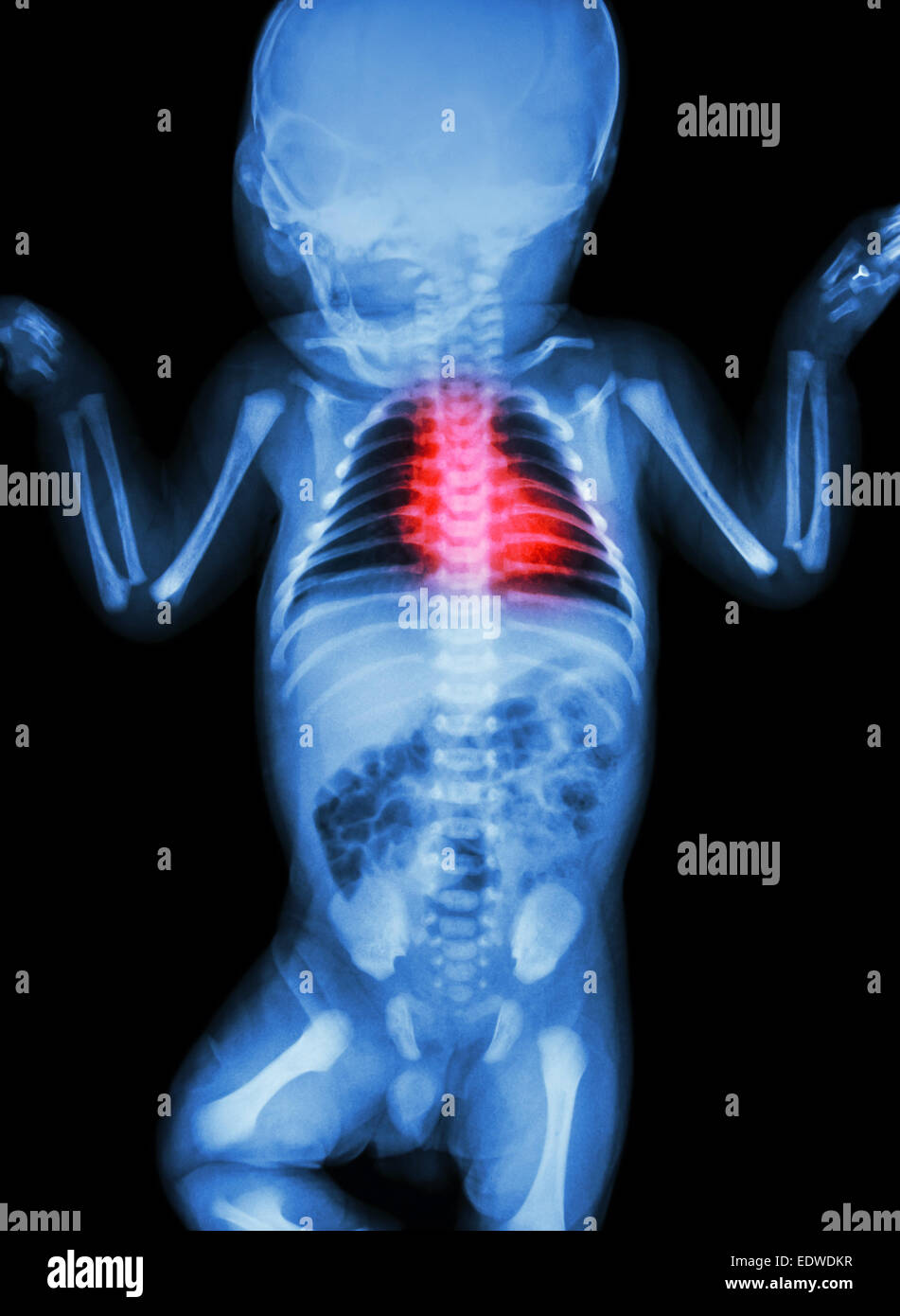 X-ray infant's body with heart disease Stock Photo