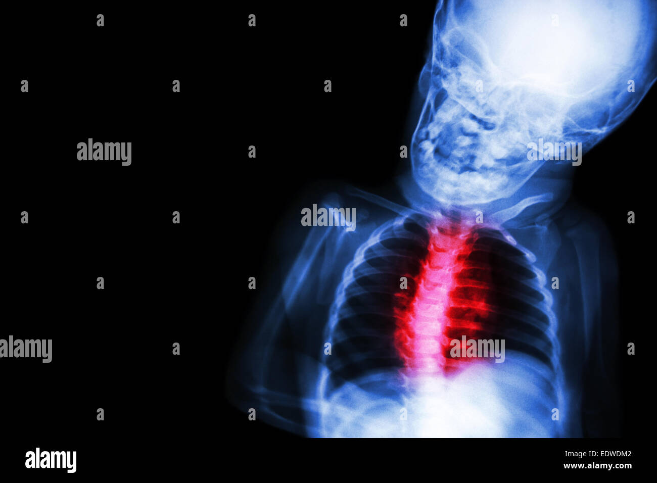 X-ray child's body with 'Congenital heart disease' Stock Photo