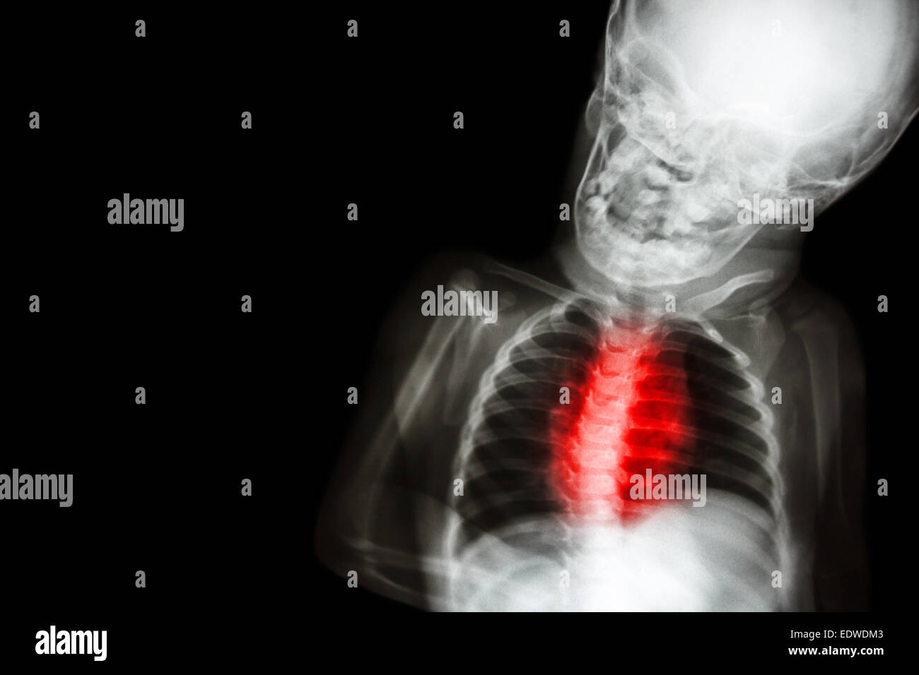 X-ray child's body with 'Congenital heart disease' Stock Photo