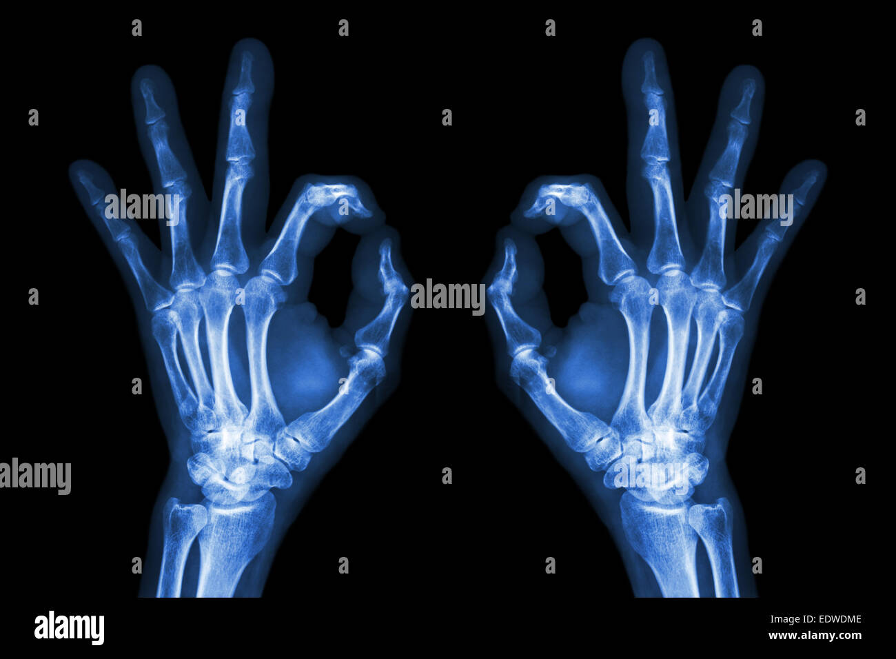 X-ray hands with OK sign Stock Photo