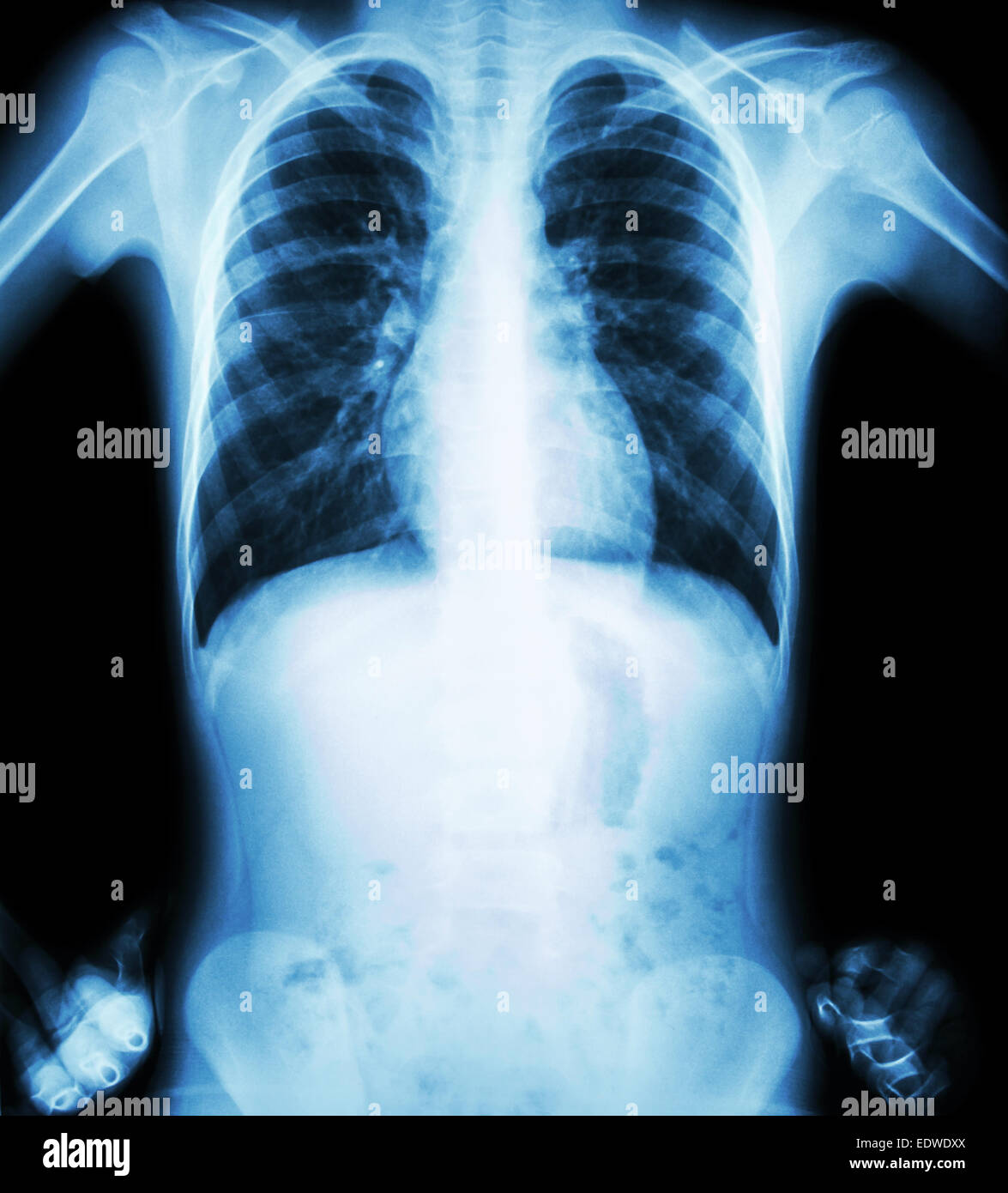 X-ray chest ( akimbo position ) ( front view ) Stock Photo