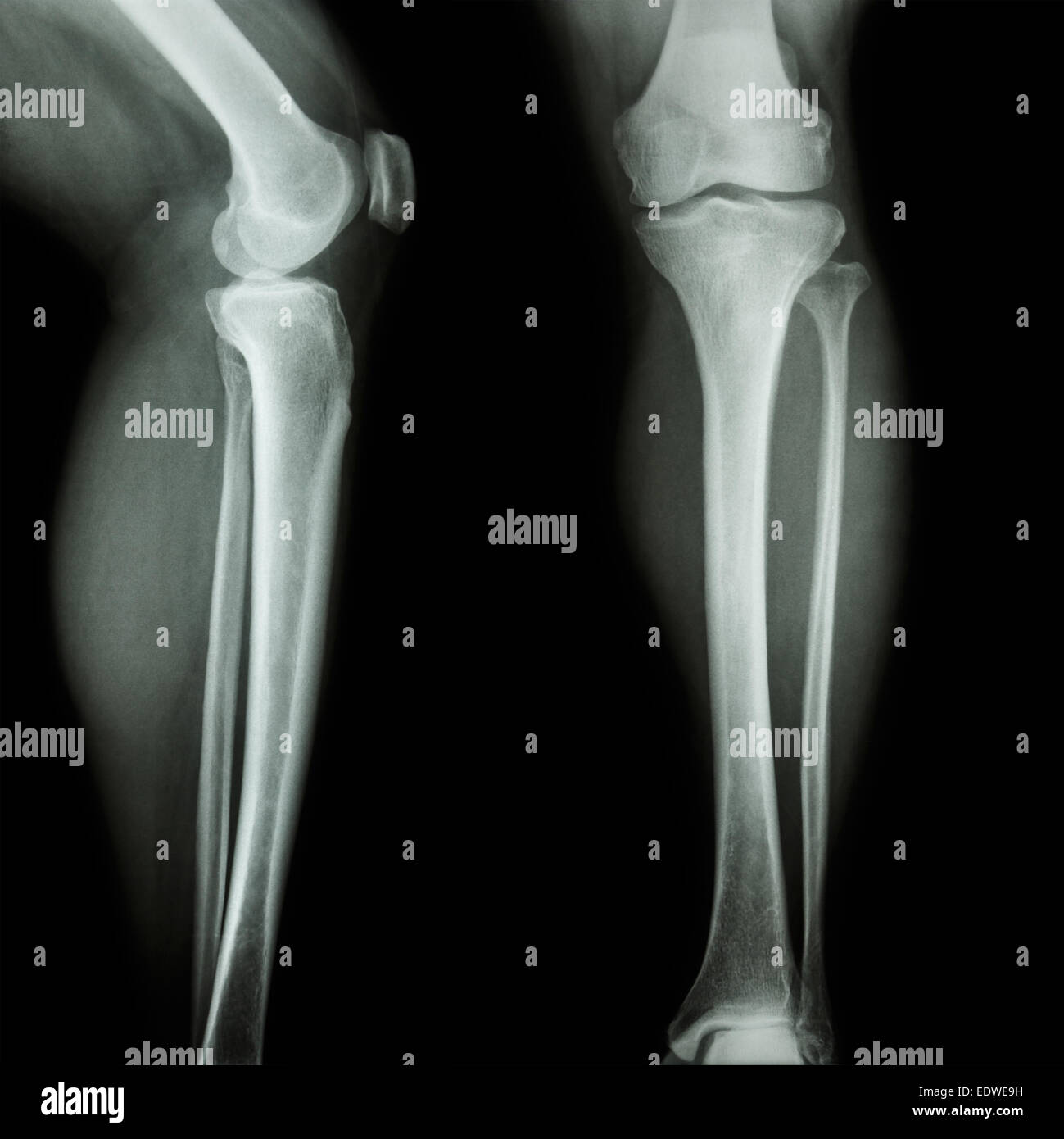 film x-ray leg & knee AP(Anterior-Posterior)/lateral Stock Photo