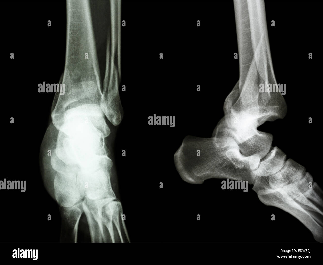 film x-ray ankle AP/Lateral : show fracture distal tibia and fibula (leg's bone) and ankle joint dislocation Stock Photo