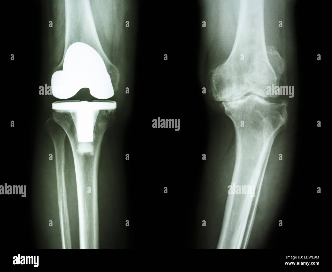 film x-ray knee of osteoarthritis knee patient and artificial joint Stock Photo